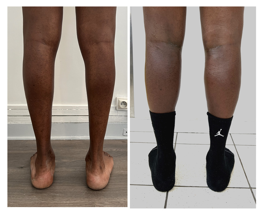 Augmentation du mollet - Patient 03