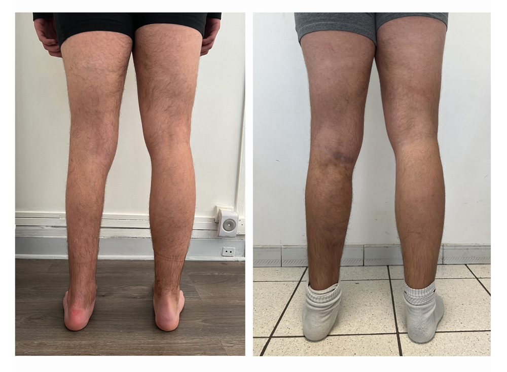 Augmentation du mollet - Patient 05