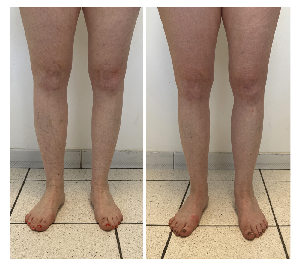 Augmentation du mollet - Patient 06