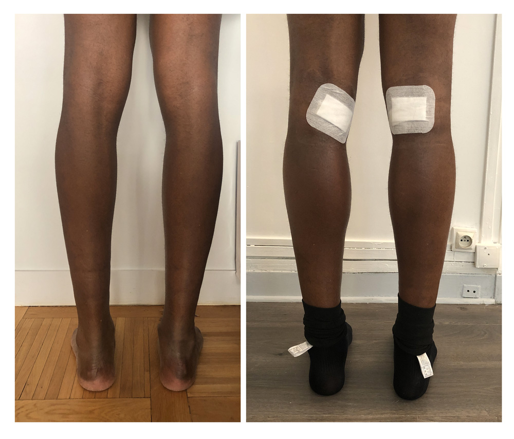 Augmentation du mollet - Patient 08