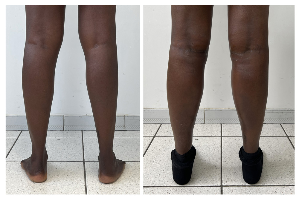 Augmentation du mollet - Patient 09