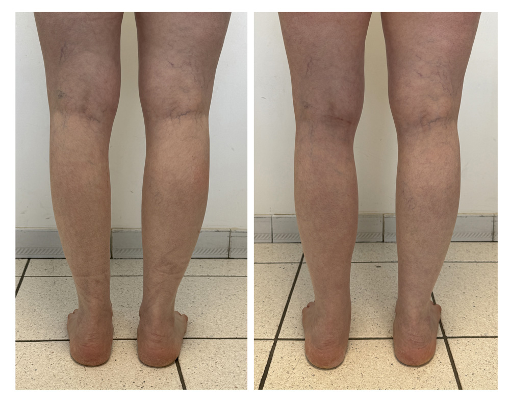 Augmentation du mollet - Patient 10