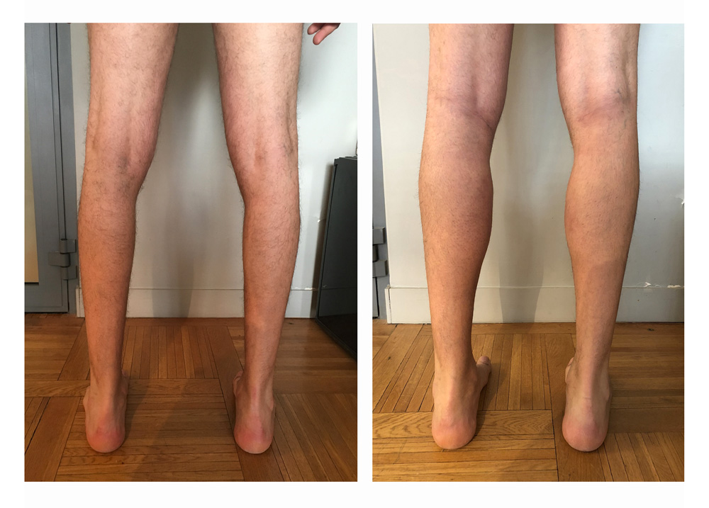 Augmentation du mollet - Patient 11