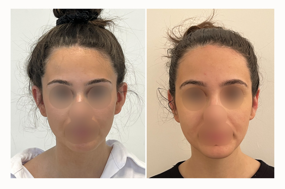 Otoplastie - Patient 20