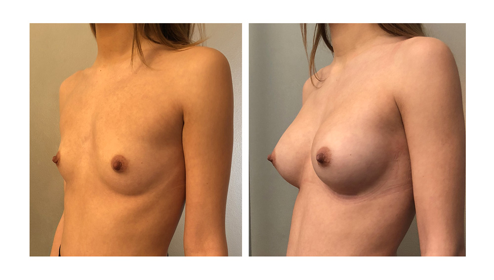 Augmentation mammaire par prothèses - Patiente 01