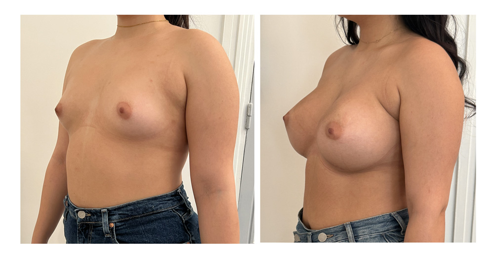 Augmentation mammaire par prothèses - Patiente 06