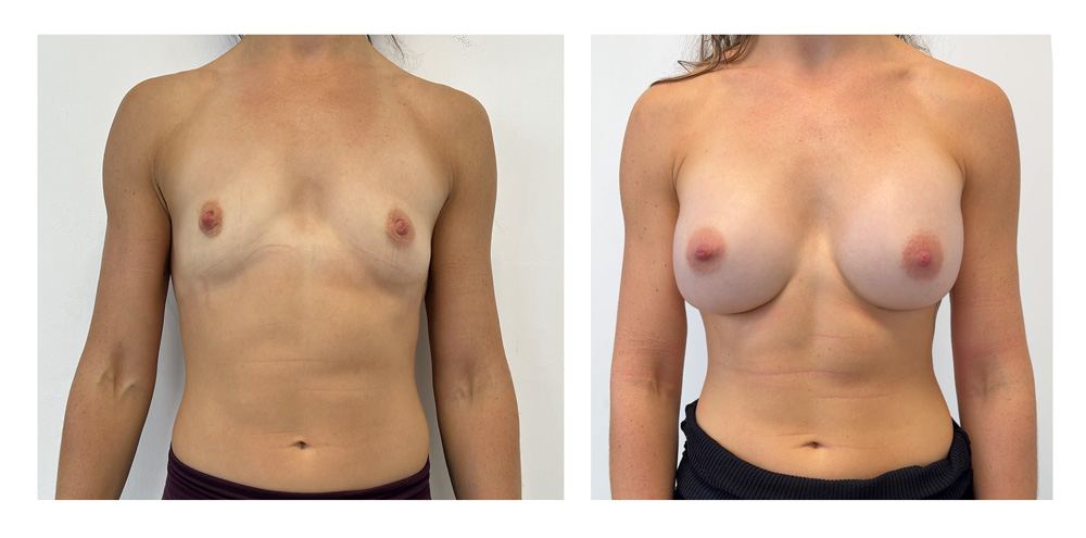 Augmentation mammaire par prothèses - Patiente 10