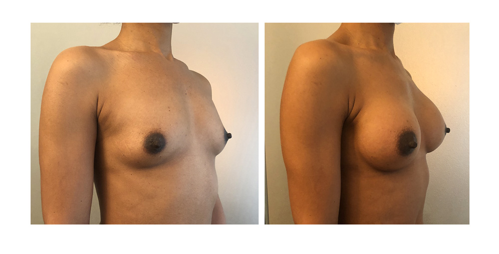 Augmentation mammaire par prothèses - Patiente 13