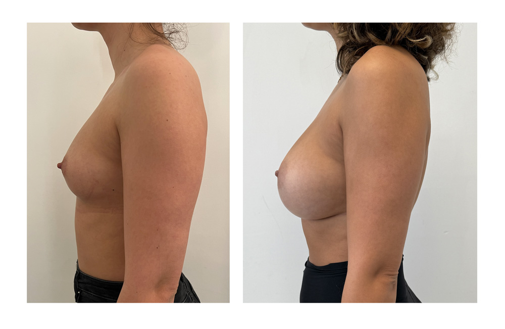 Augmentation mammaire par prothèses - Patiente 14