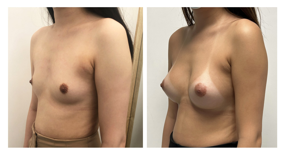 Augmentation mammaire par prothèses - Patiente 18