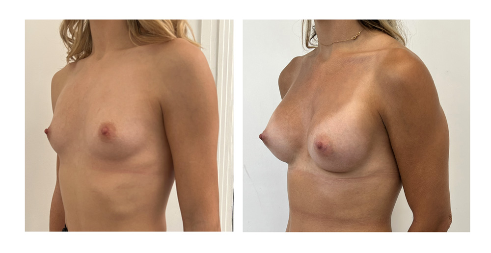 Augmentation mammaire par prothèses - Patiente 19