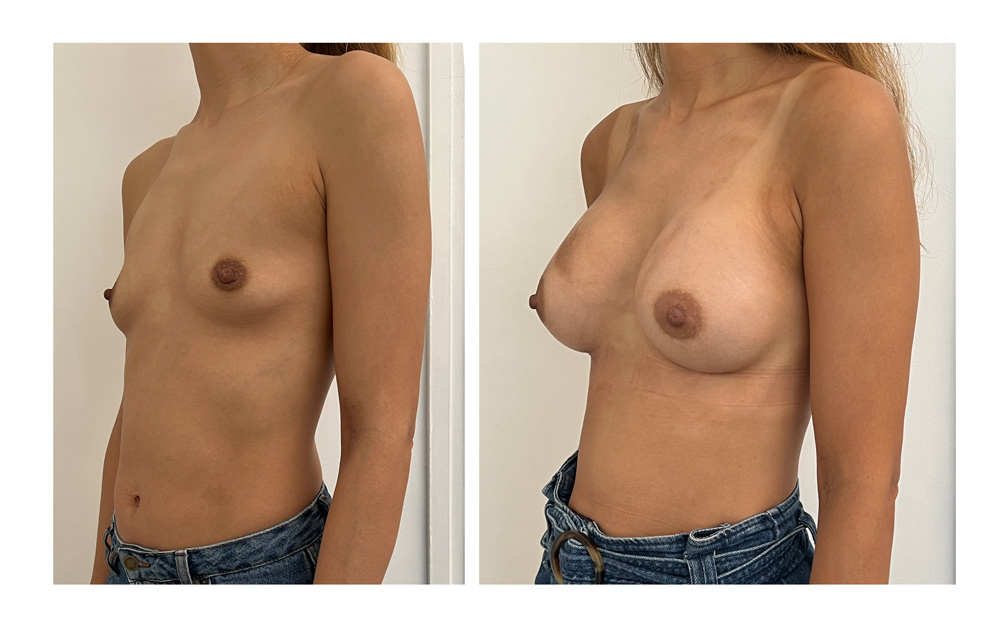 Augmentation mammaire par prothèses - Patiente 21