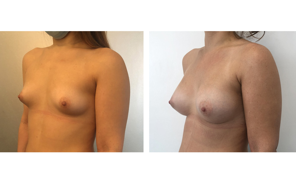 Augmentation mammaire par prothèses - Patiente 22
