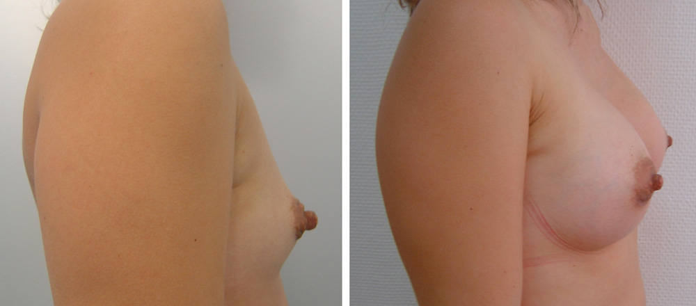Augmentation mammaire par prothèses - Patiente 23