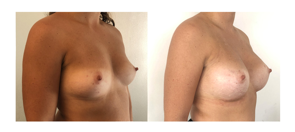 Augmentation mammaire par prothèses - Patiente 24