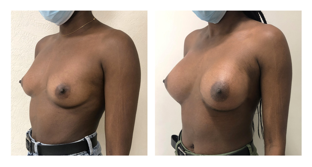 Augmentation mammaire par prothèses - Patiente 29