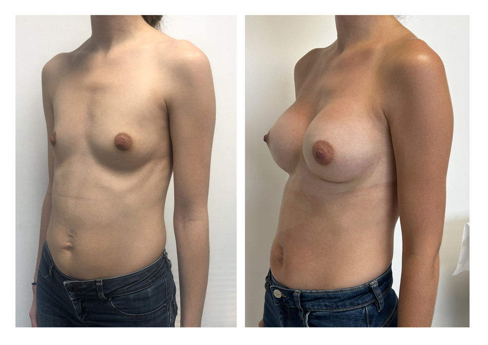 Augmentation mammaire par prothèses - Patiente 30