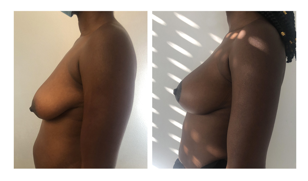 Ptose mammaire - Patient 02