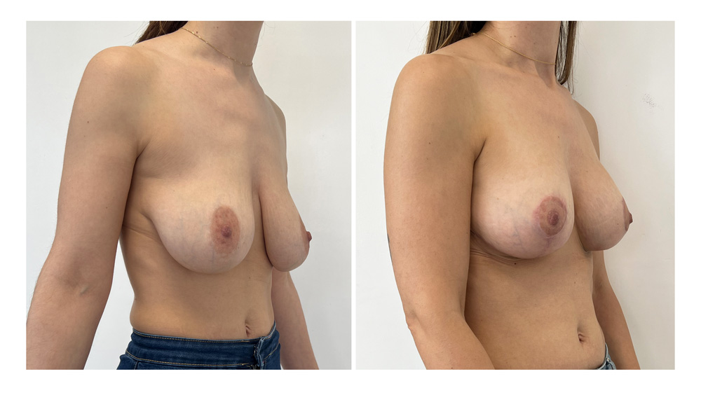 Ptose mammaire - Patient 10