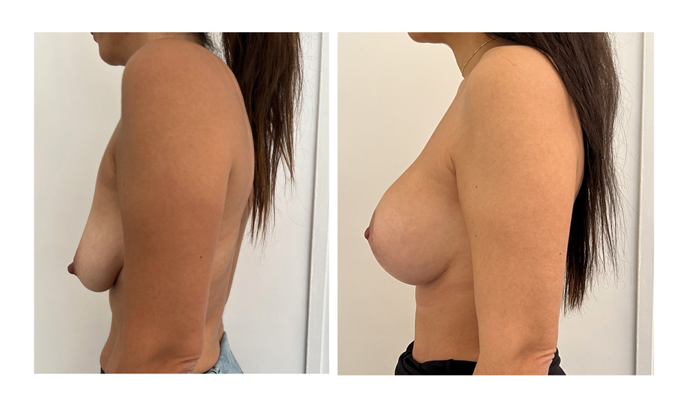 Ptose mammaire - Patient 12