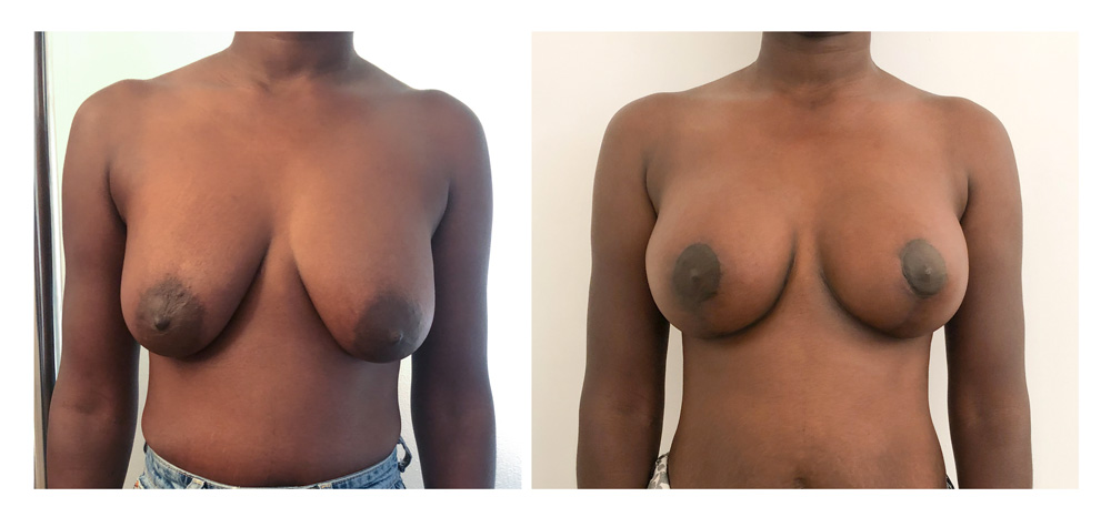 Ptose mammaire - Patient 13