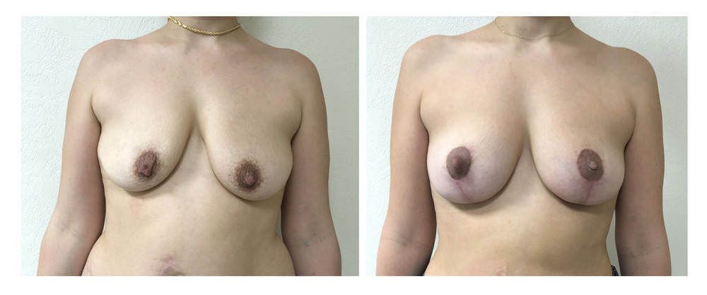 Ptose mammaire - Patient 15