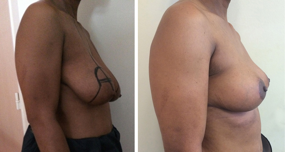 Ptose mammaire - Patient 19