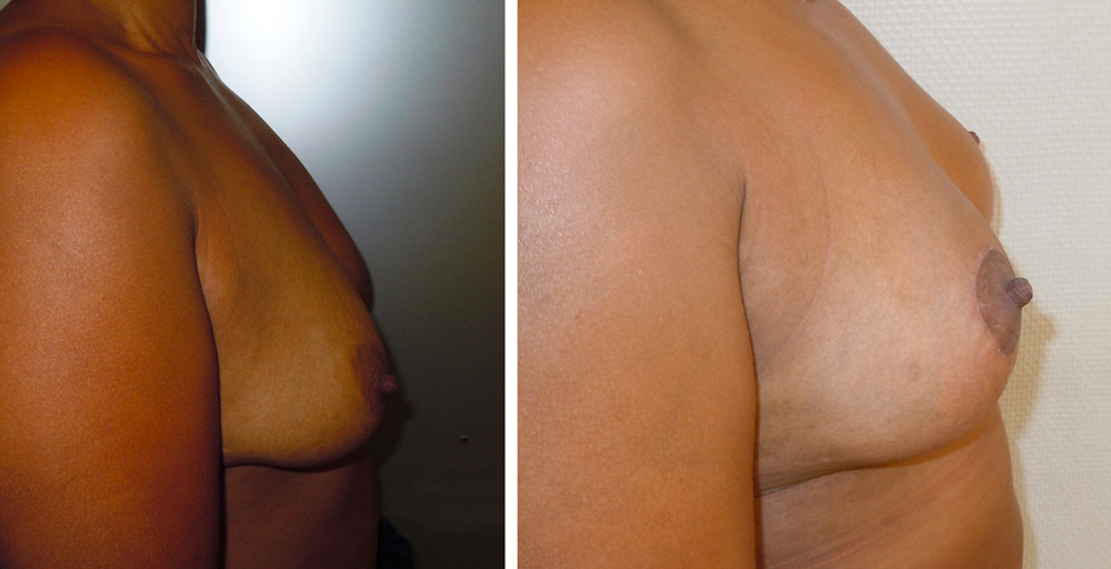 Ptose mammaire - Patient 23