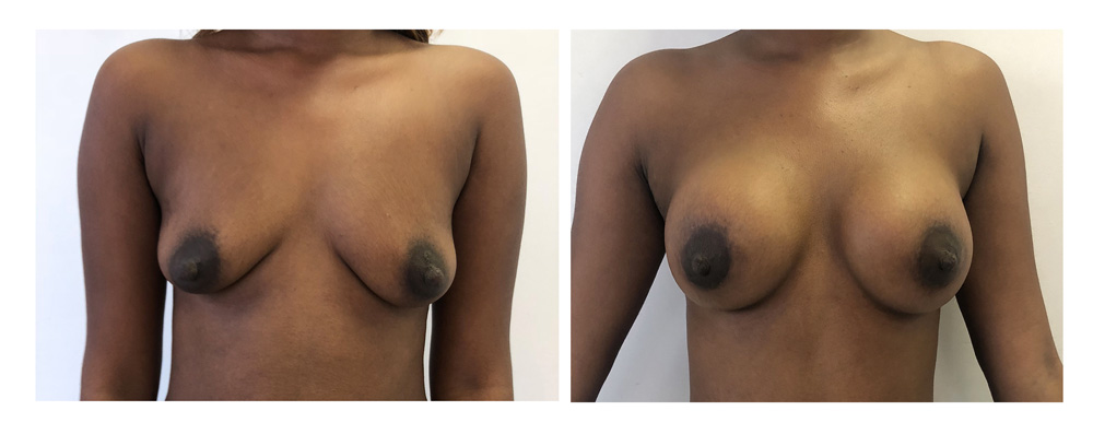 Ptose mammaire - Patient 24