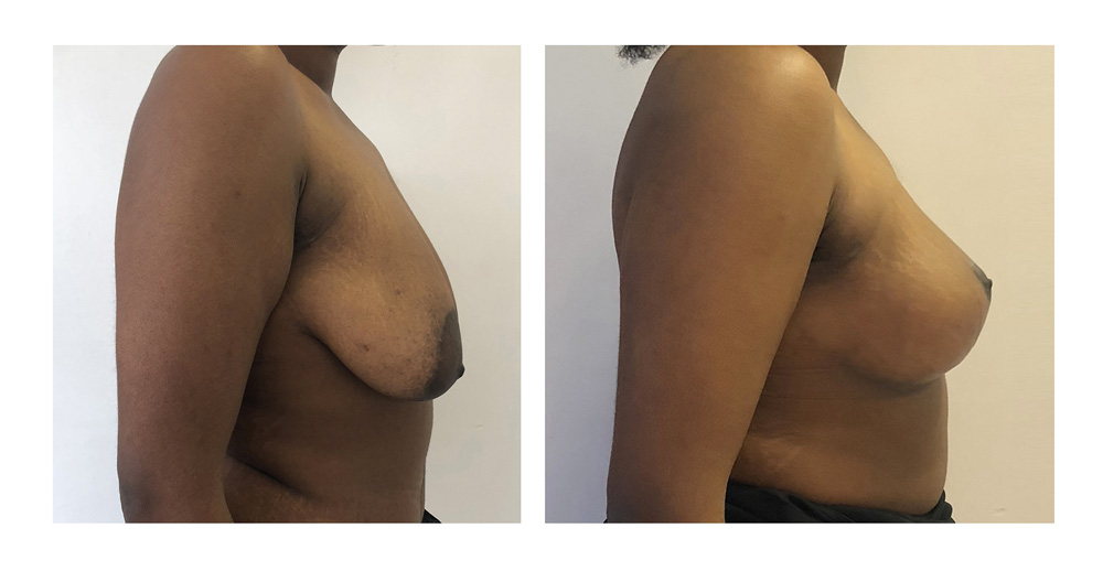 Ptose mammaire - Patient 25