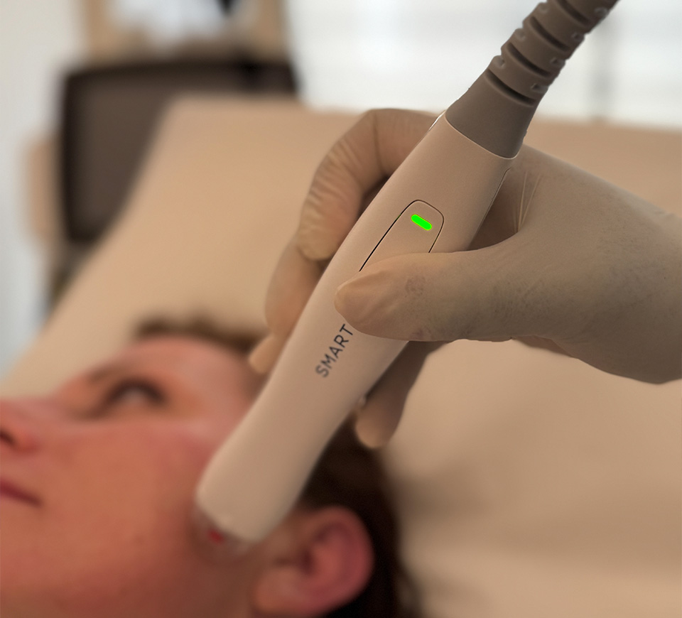 Radiofréquence micro-needling