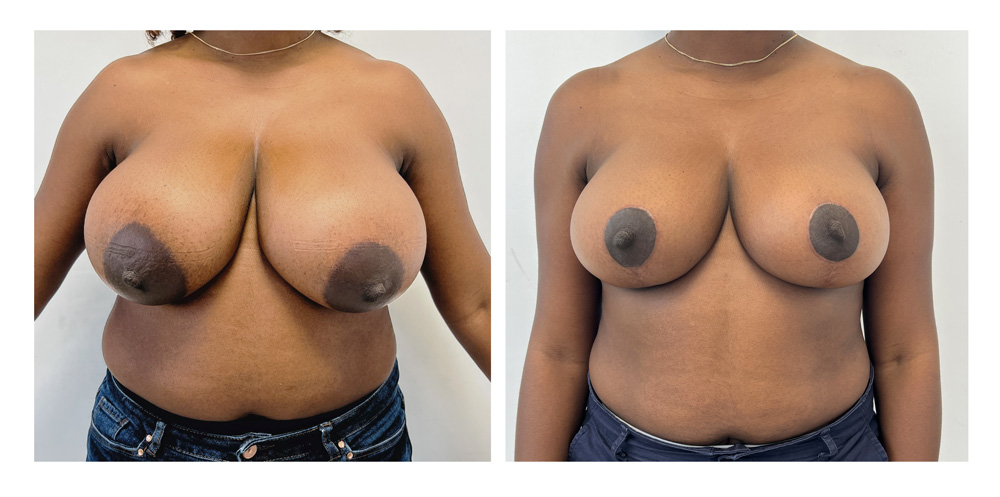 Réduction mammaire - Patiente 1