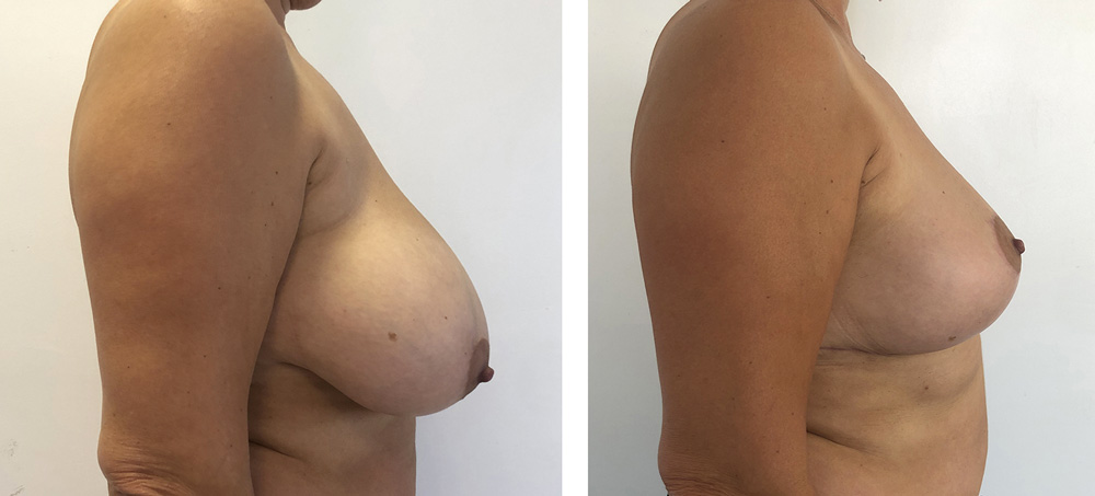 Réduction mammaire - Patiente 2