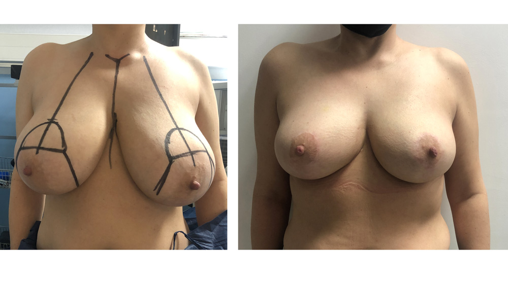 Réduction mammaire - Patiente 3