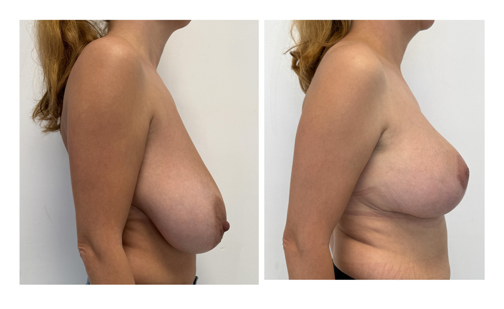 Réduction mammaire - Patiente 4