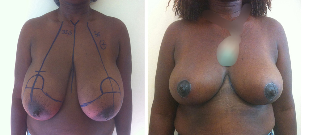 Réduction mammaire - Patiente 6