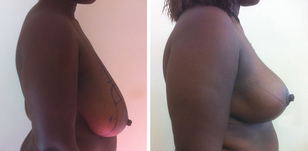 Réduction mammaire - Patiente 7