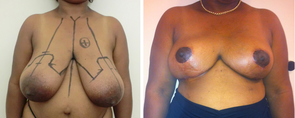Réduction mammaire - Patiente 8