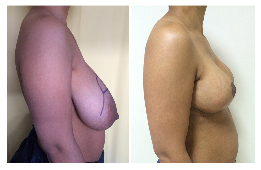 Réduction mammaire - Patiente 9