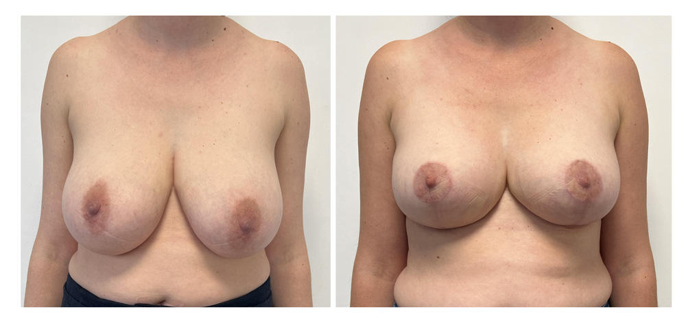 Réduction mammaire - Patiente 10