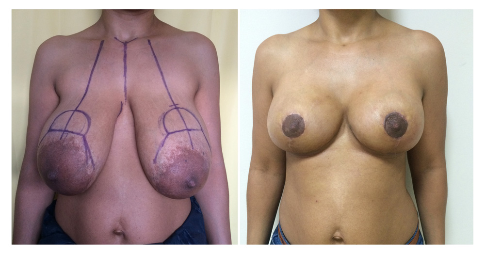 Réduction mammaire - Patiente 11