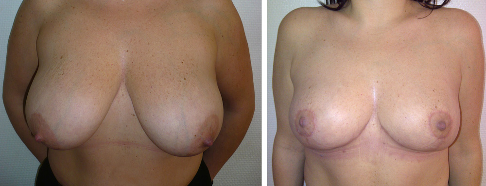 Réduction mammaire - Patiente 14