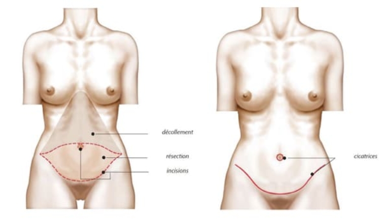 Schéma incision abdominoplastie
