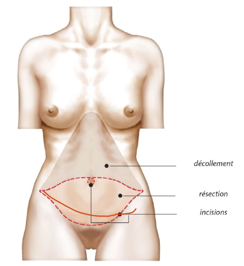 Abdominoplastie ombilicale