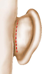 Incision otoplastie