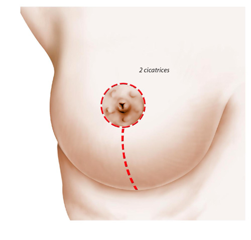 Cicatrice verticale