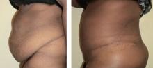 Abdominoplastie avant/après