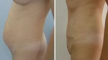 Abdominoplastie avant/après