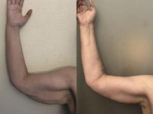Brachioplastie / lifting des bras - Patiente 3
