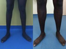 Augmentation du mollet - Patient 1